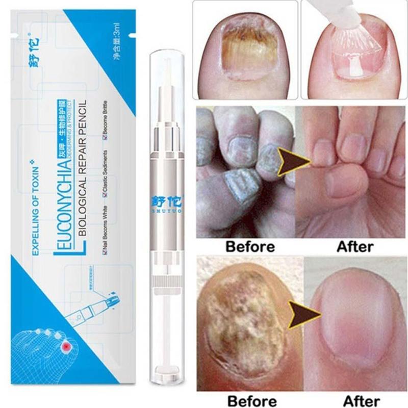 1Pcs Nail Fungal Treatment Pen Anti Fungus Infection Biological Repair Solution Nutritious Oil 3ml Restores Healthy Toenails