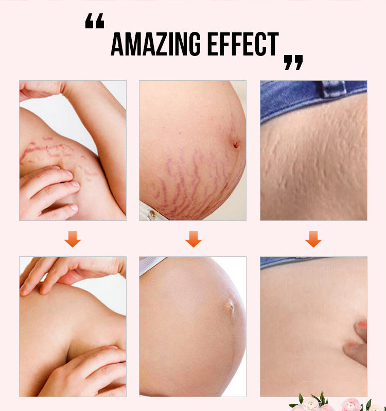 Reduce Postpartum Obesity And Stretch Marks Repair Essential Oil