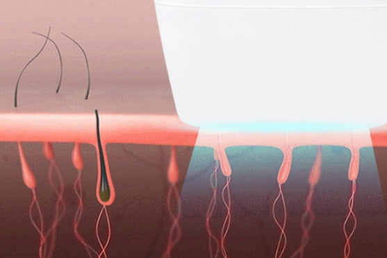 Laser-Haarentfernung für den Haushalt, Ganzkörper-Photonen-Achselhöhle, privater Schönheitssalon, Haarentfernung, 300.000 Haarentfernungsinstrument